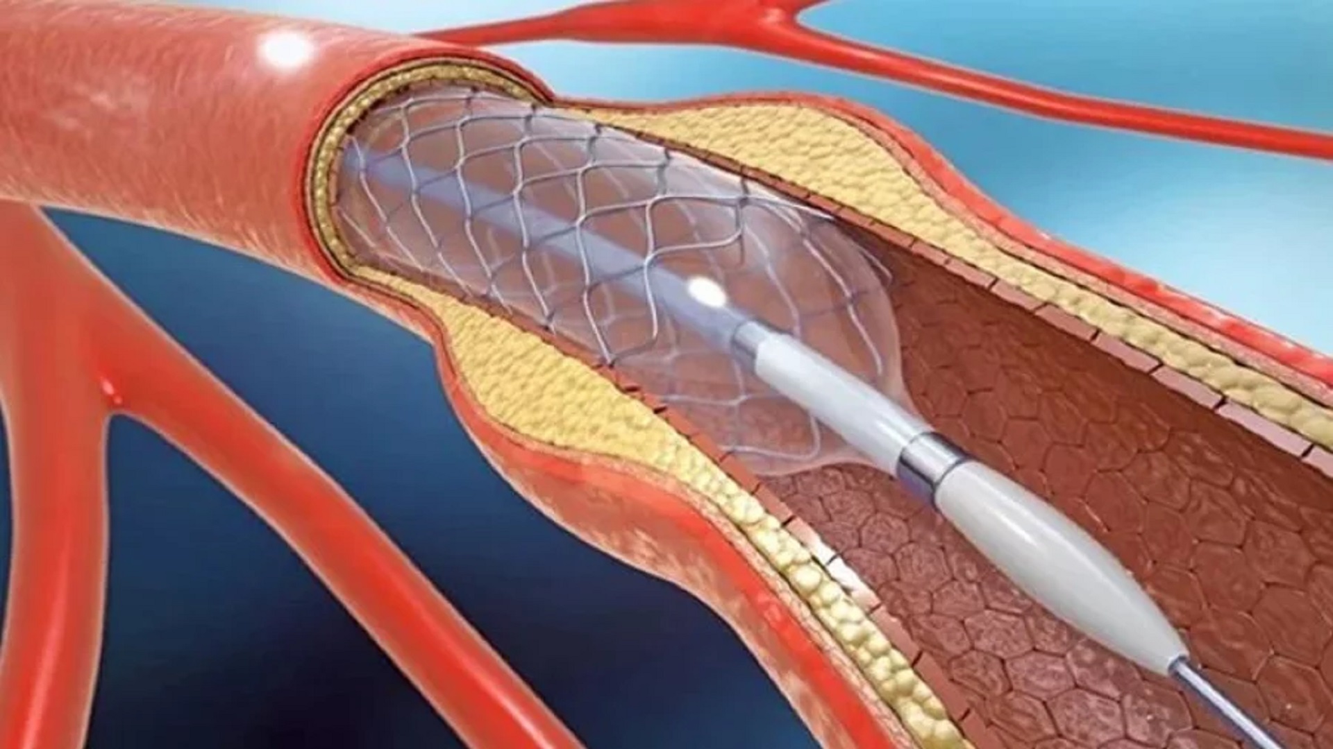 Robotic Angioplasty – Robotic Assisted Angioplasty – 1st Time in Bangladesh