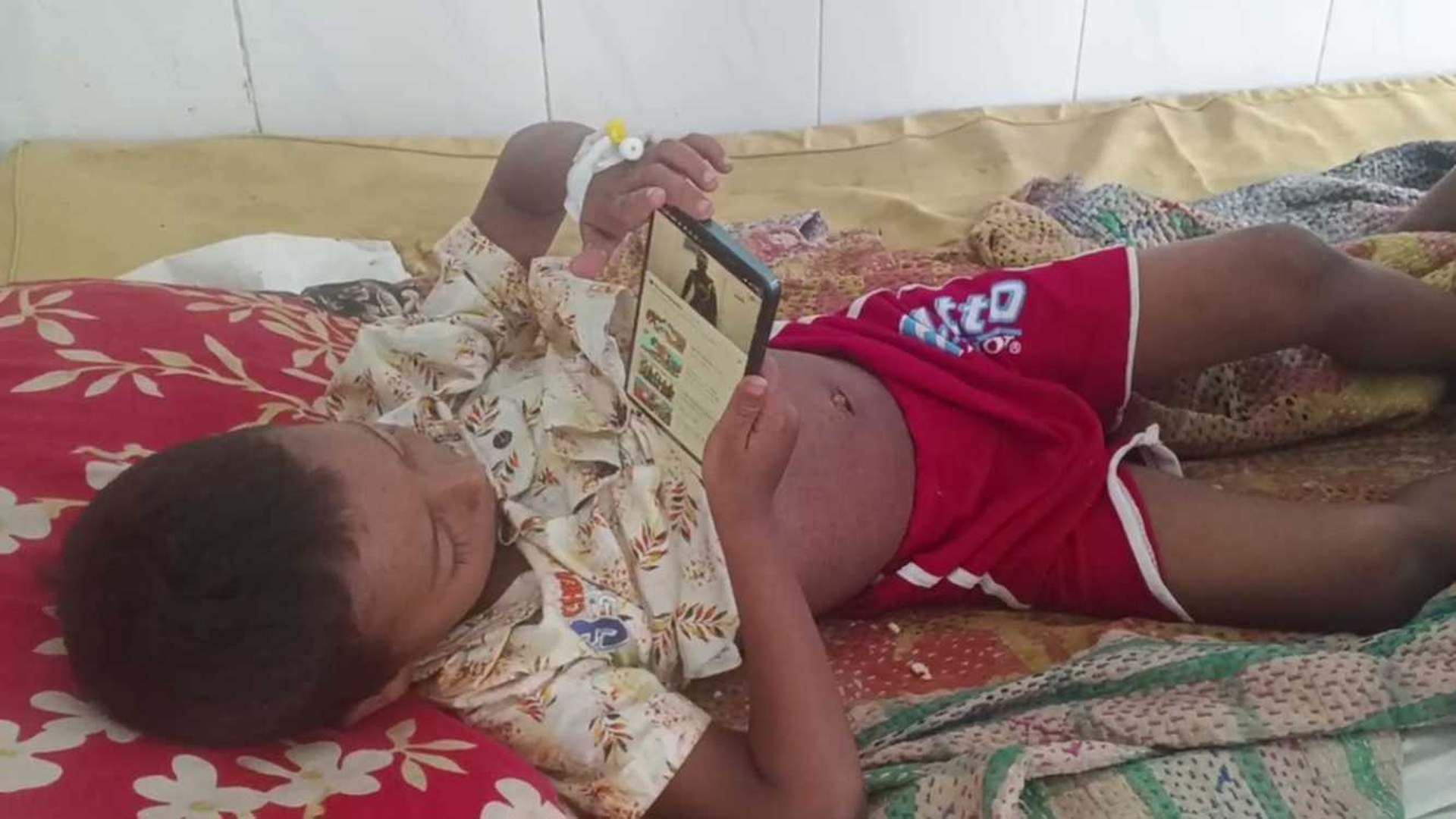 গাইবান্ধায় হাম উপসর্গ নিয়ে ৩ শিশু হাসপাতালে