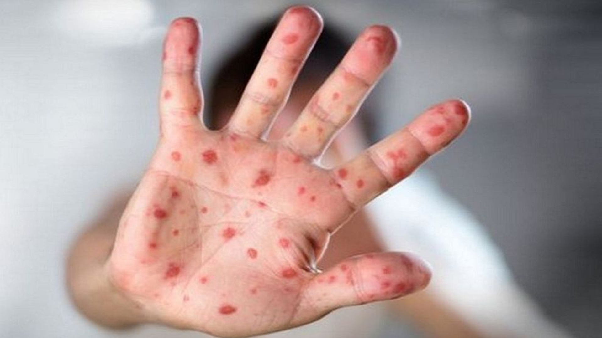 ৬ ধরনের খাবারে দ্রুত সেরে উঠবে হাম