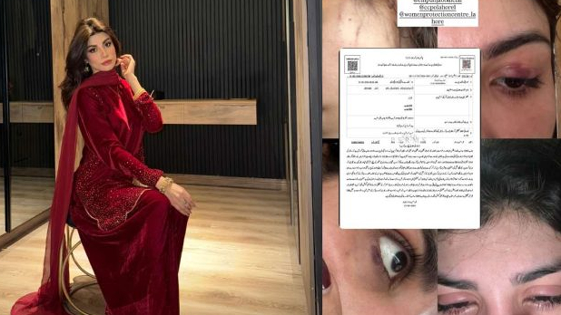 মামলার পর শরীরে আঘাতের চিহ্ন দেখালেন পাকিস্তানি মডেল