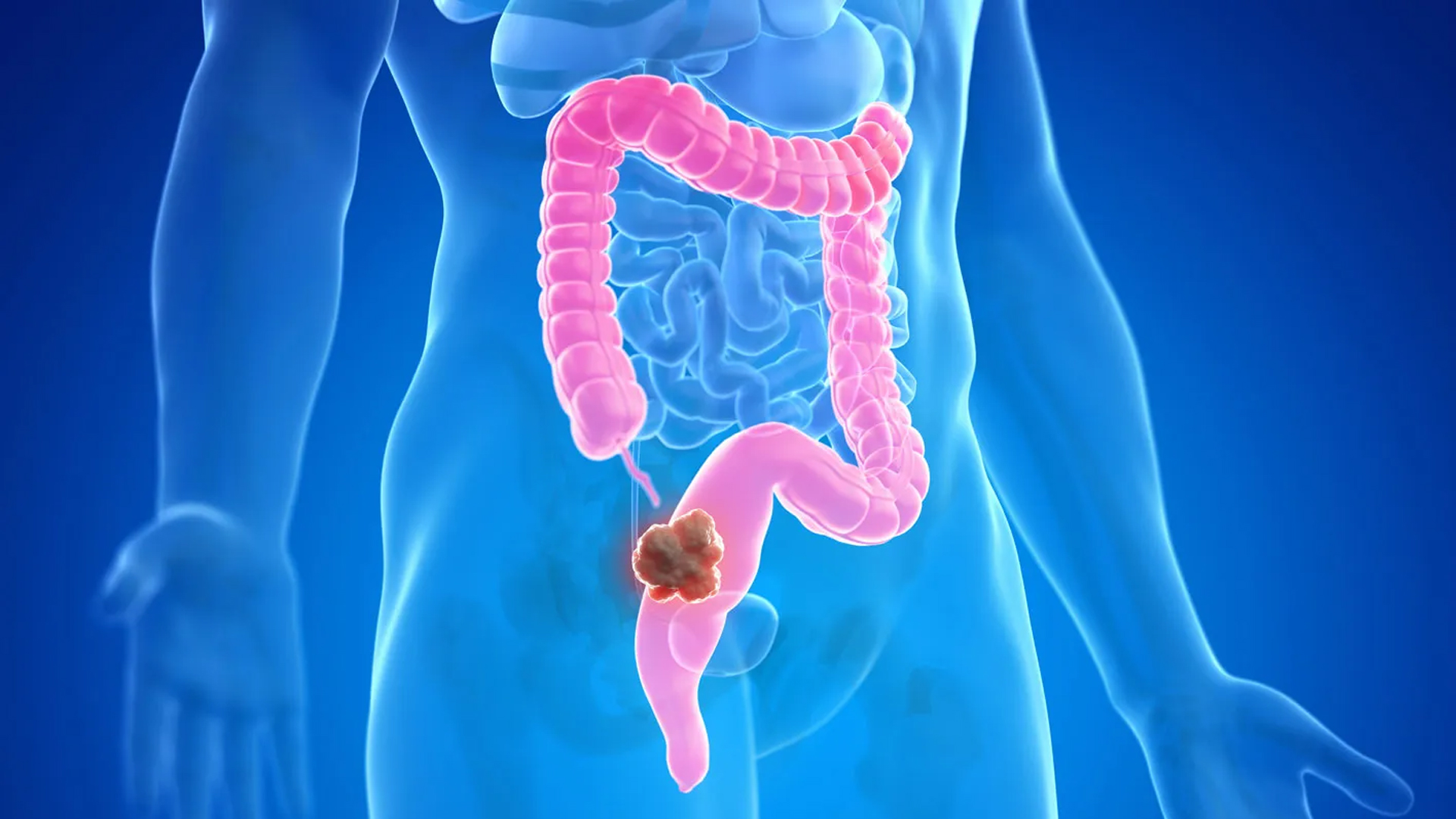 কোলোরেক্টাল ক্যানসারের প্রাথমিক ৪ সংকেত এড়িয়ে যাচ্ছেন নাতো?