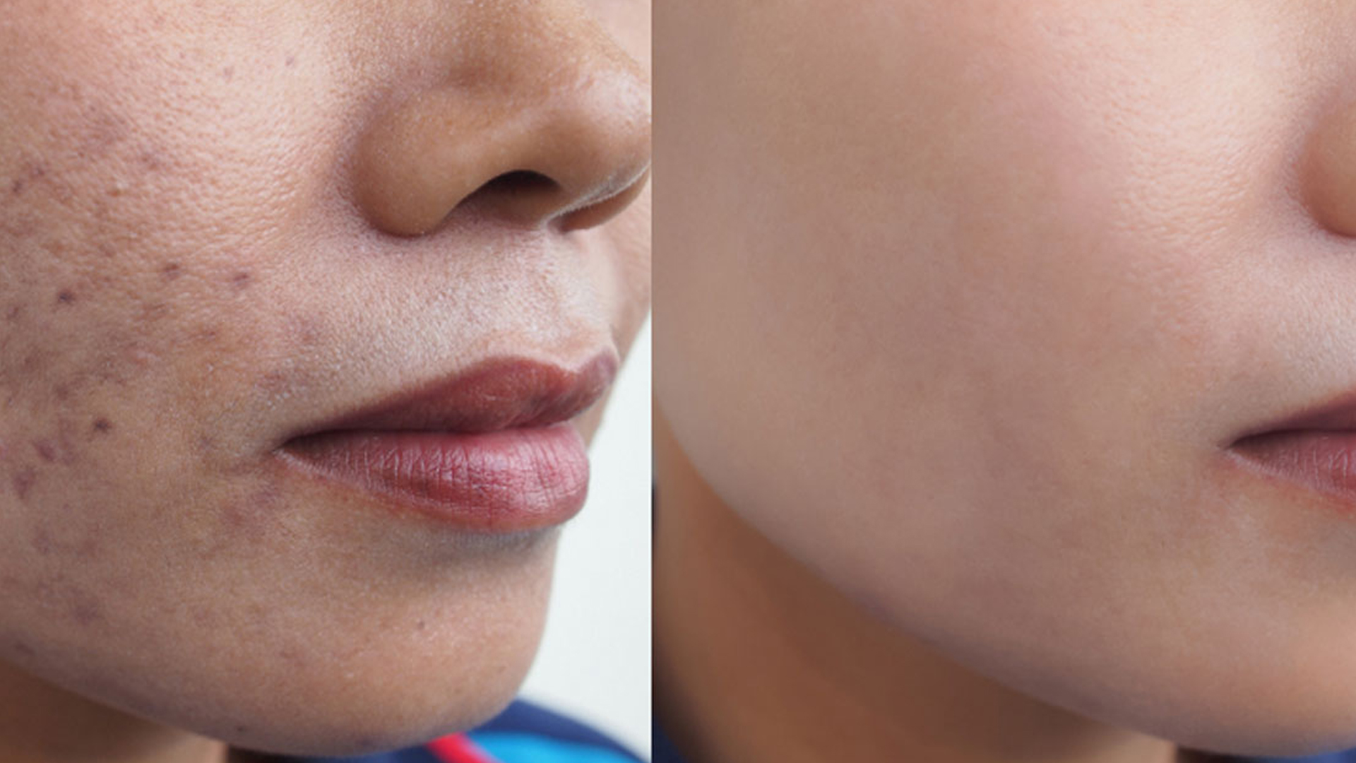 ব্রণ দূর করার উপায়: কার্যকরী ঘরোয়া সমাধান