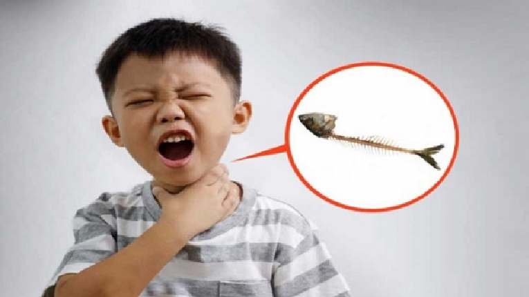 গলায় মাছের কাটা বিঁধলে করণীয়: দ্রুত আরোগ্যের উপায়