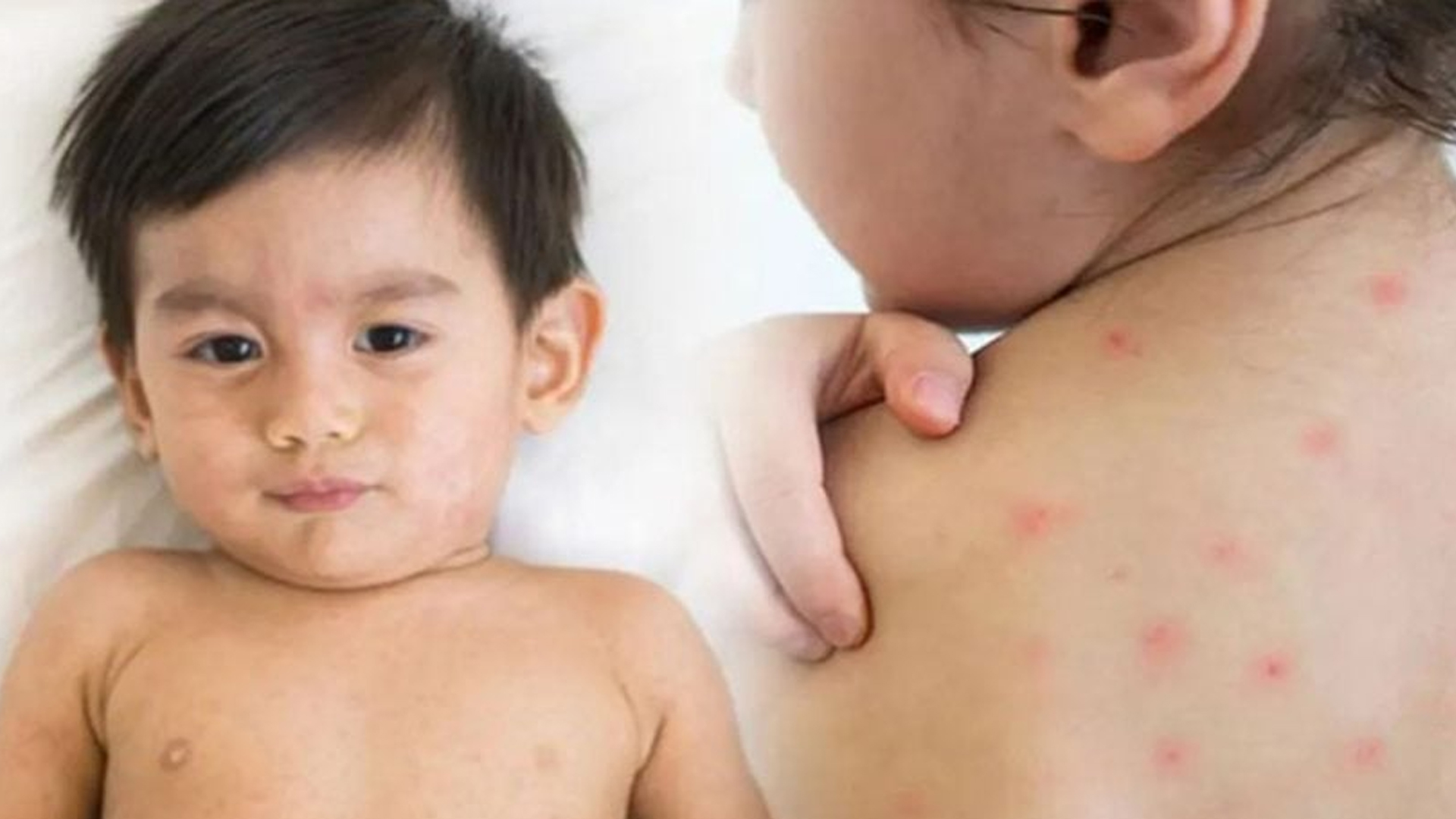 হাম মোকাবিলায় ইসলাম ও বিজ্ঞান