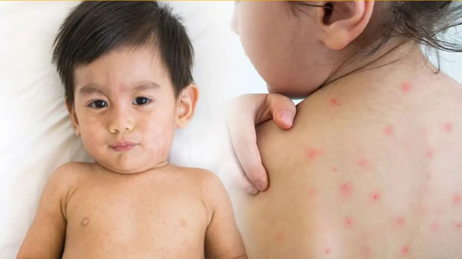 হাম প্রতিরোধের প্রধান ৫ উপায়