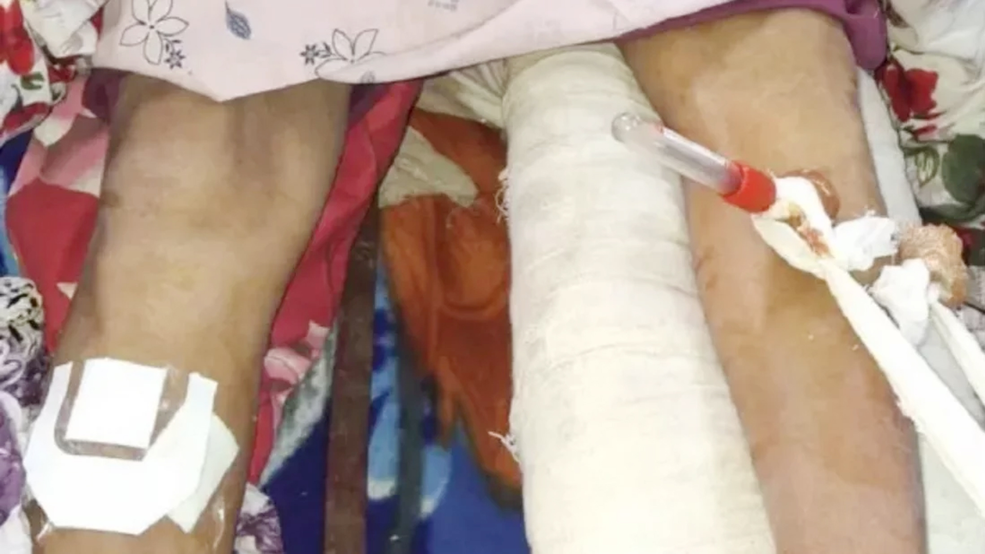 বাম পায়ের হাড় ভাঙা রোগীর অপারেশন হলো ডান পায়ে