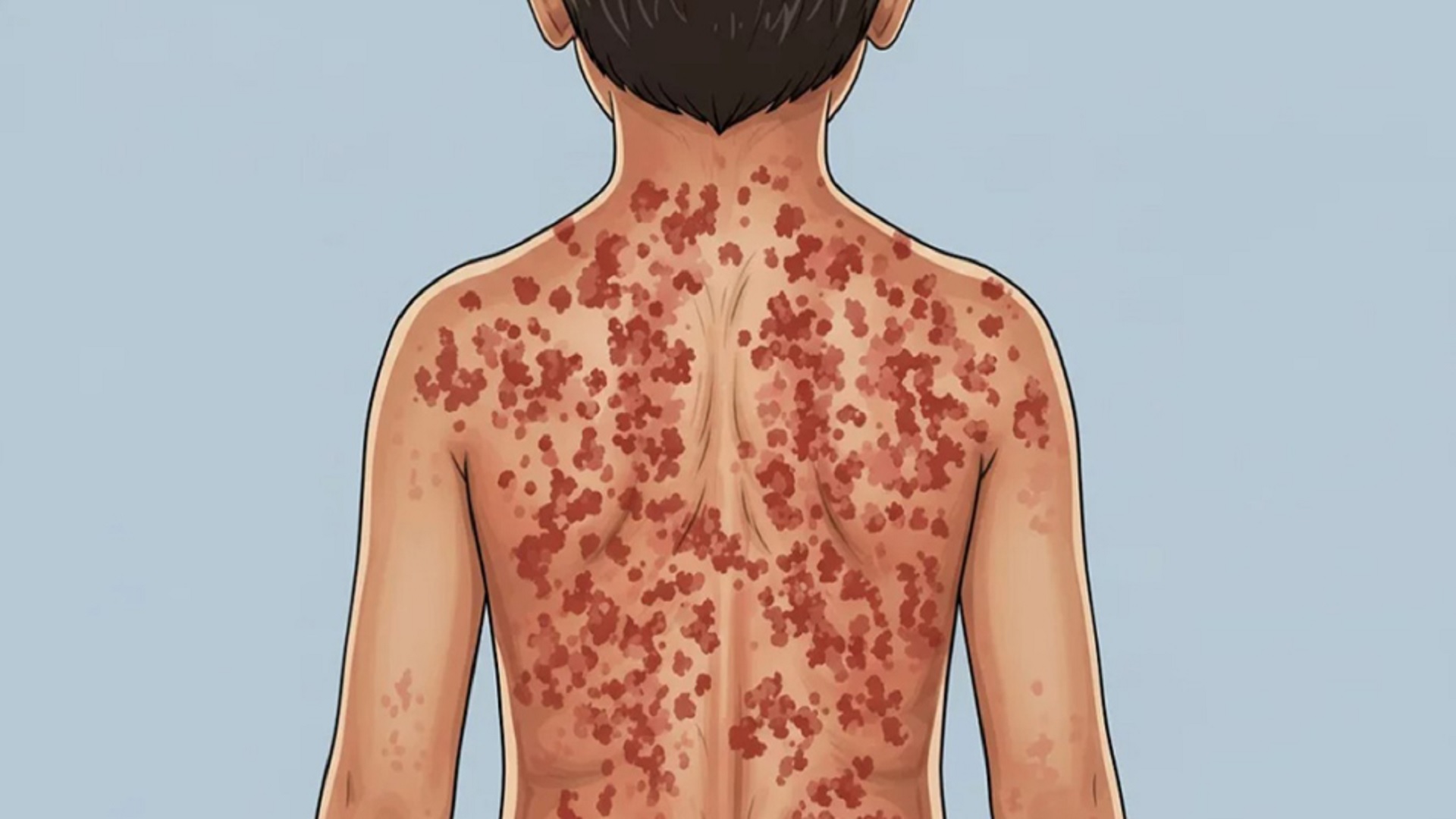 হামের প্রাদুর্ভাব নিয়ে ভয়ংকর তথ্য!