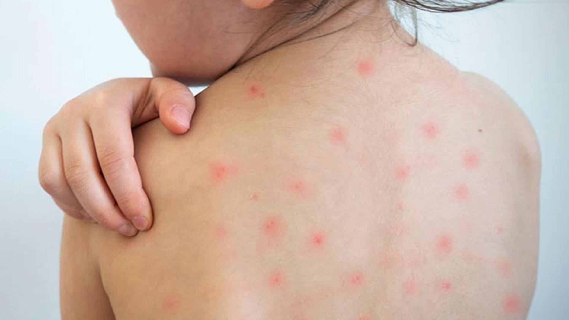 ২৪ ঘণ্টায় সন্দেহজনক হামে আক্রান্ত ৯৪৭, মৃত্যু ৩