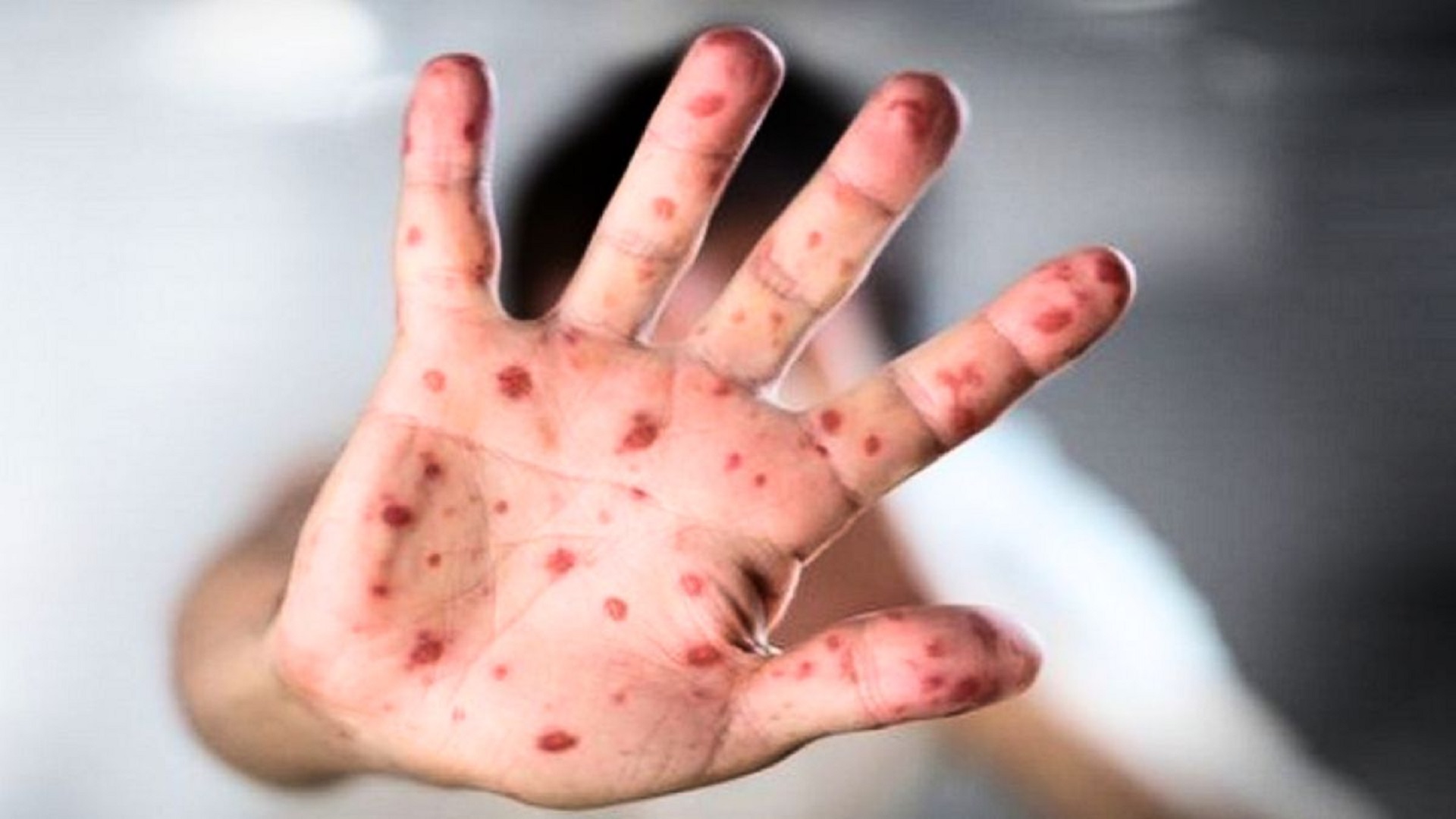 শিশুর হাম হলে যেসব খাবার ভুলেও খাওয়াবেন না