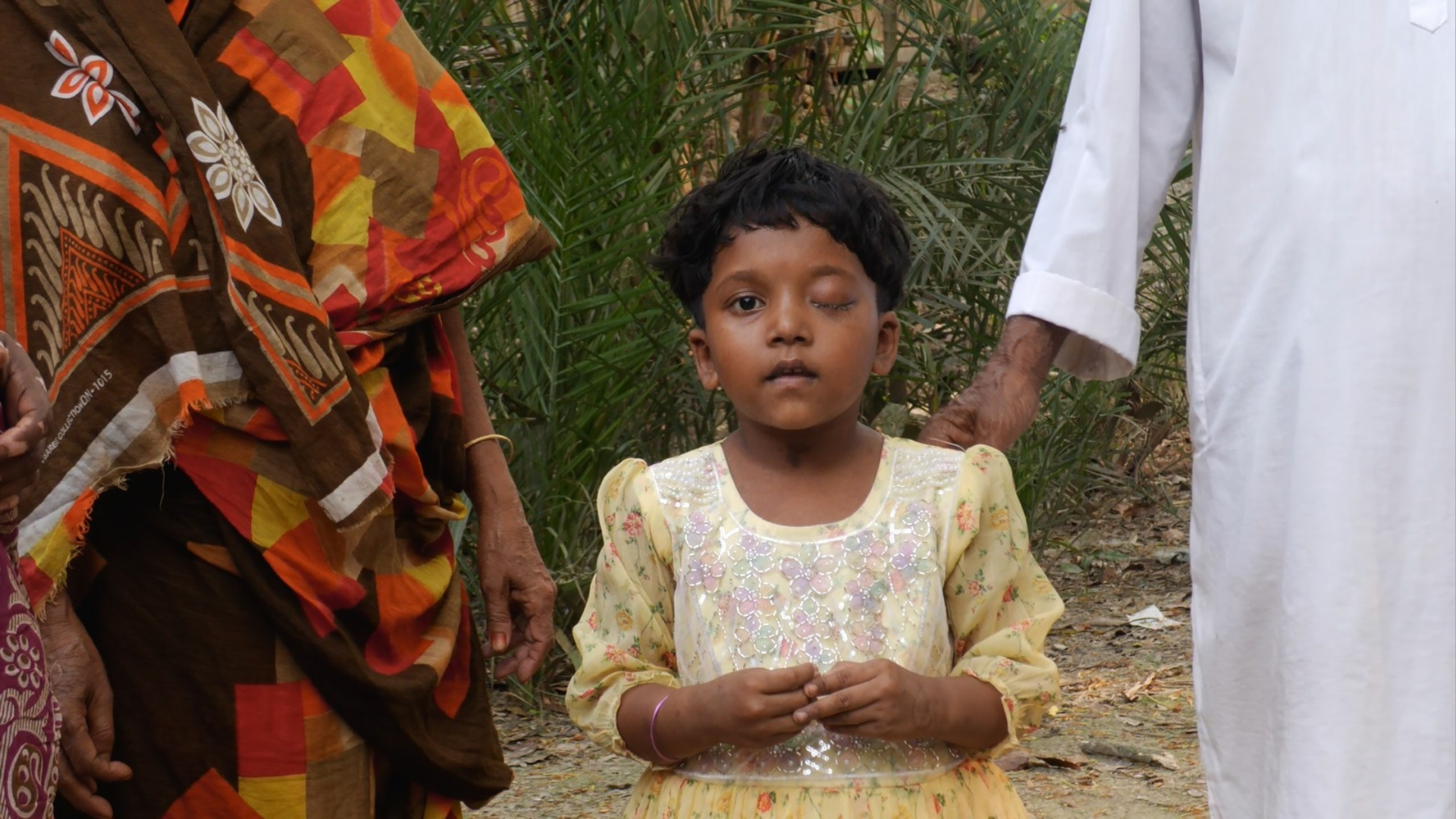এক ফোঁটা সুপার গ্লু কেড়ে নিল ছোট্ট আরিফা চোখের আলো