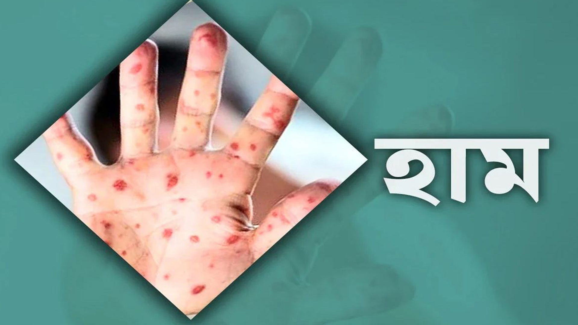 বরিশালে হাম উপসর্গে ২ শিশুর মৃত্যু