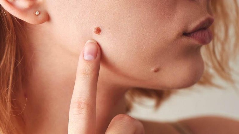 আঁচিল দূর করার উপায়: সহজ এবং কার্যকর পদ্ধতি