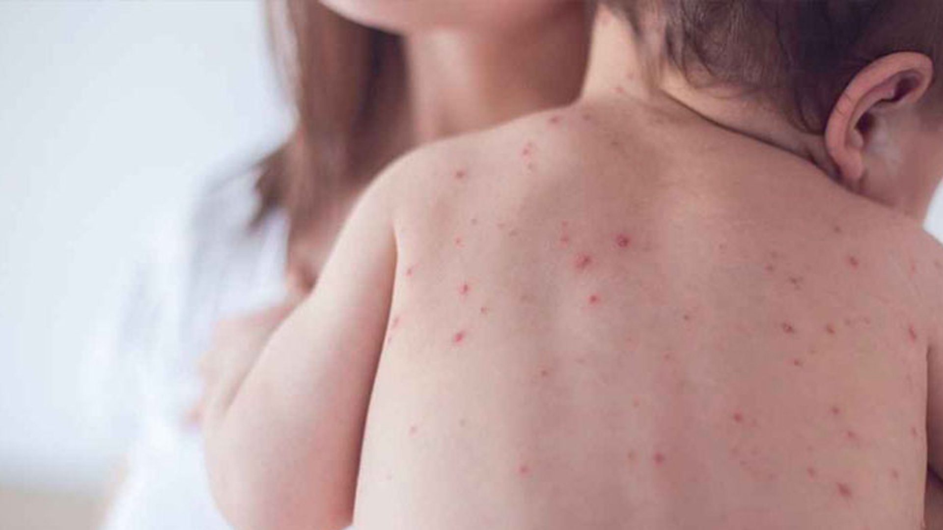 বাবা-মায়ের ৭ ভুলে হাম নিয়ে হতে পারে মারাত্মক বিপদ